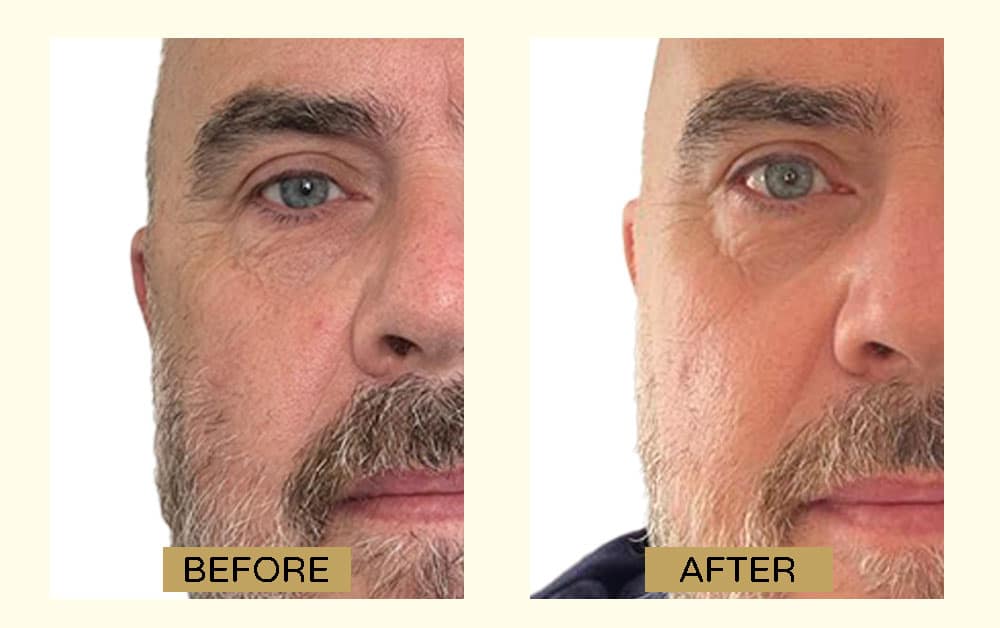 Injectable Skin Boosters Before After
